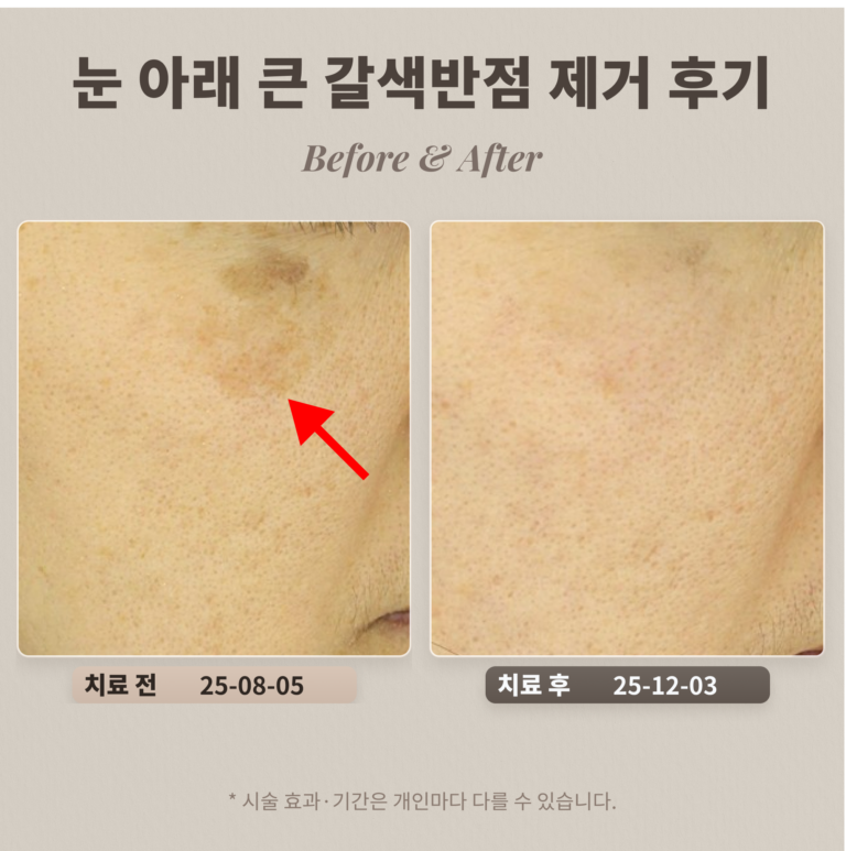 40대 여성 눈 아래 큰 갈색반점(색소침착 오인) 제거 후기_리팟레이저 후기