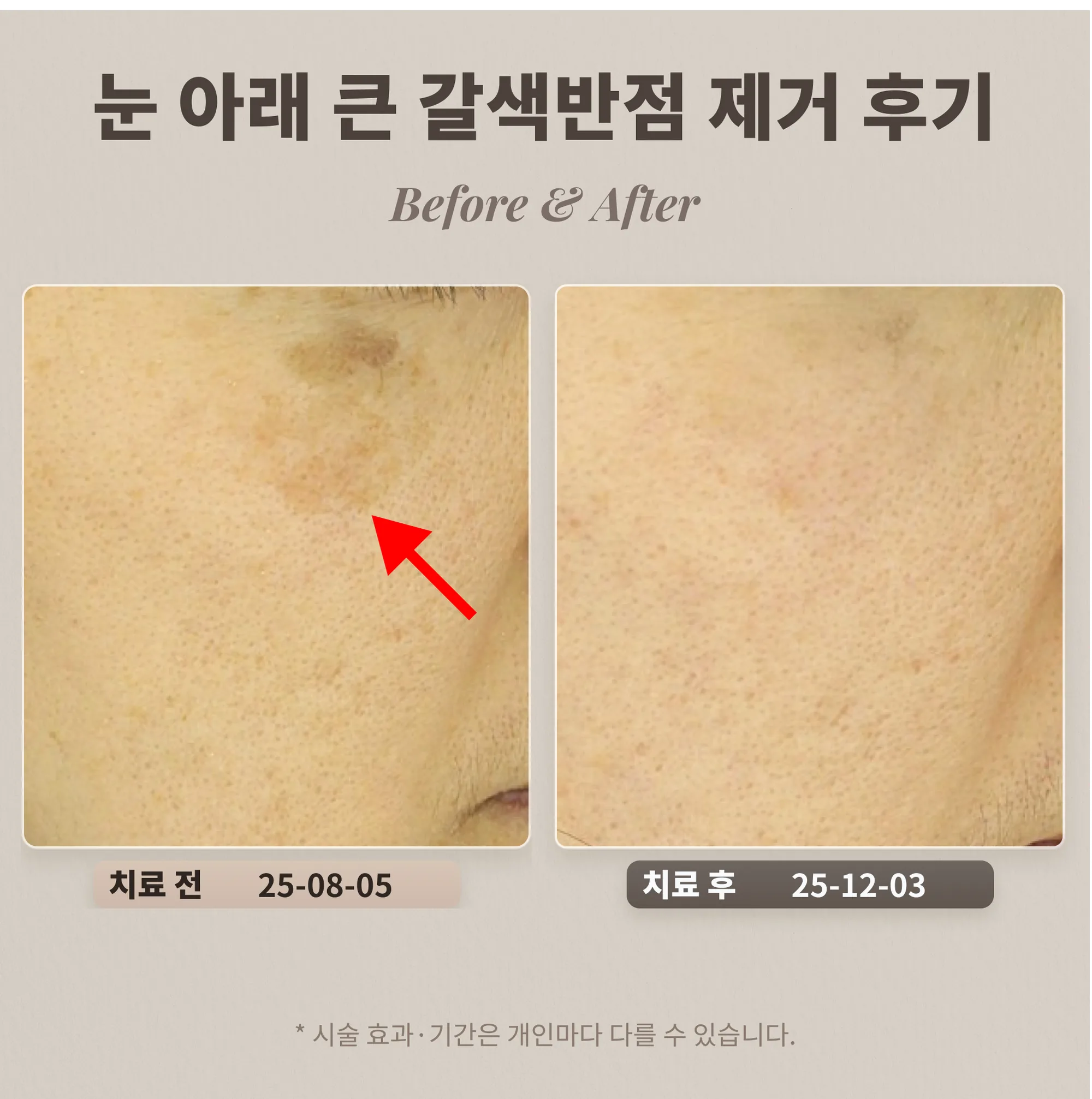 40대 여성 눈 아래 큰 갈색반점(색소침착 오인) 제거 후기_리팟레이저 후기