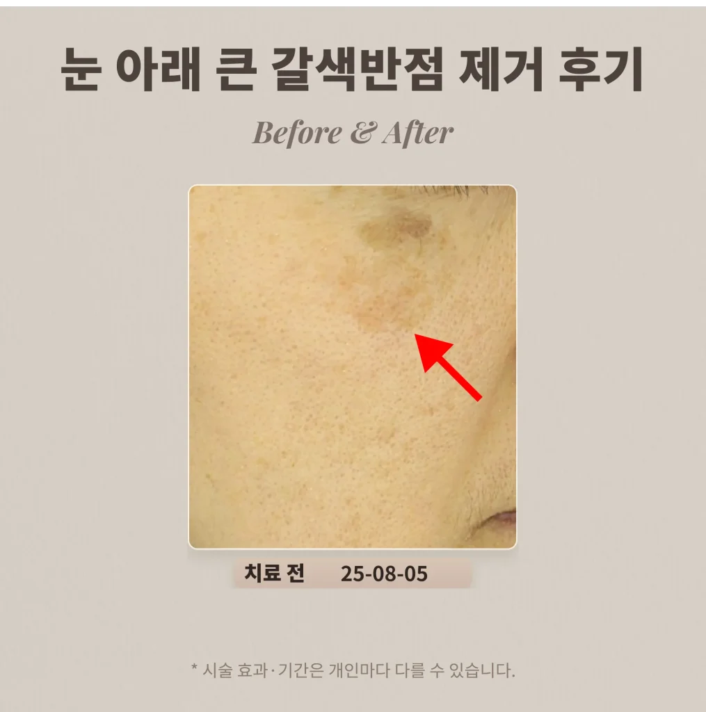 눈밑 흑자 제거 후기, 색소침착인 줄 알았던 큰 갈색 반점 (40대 여성)