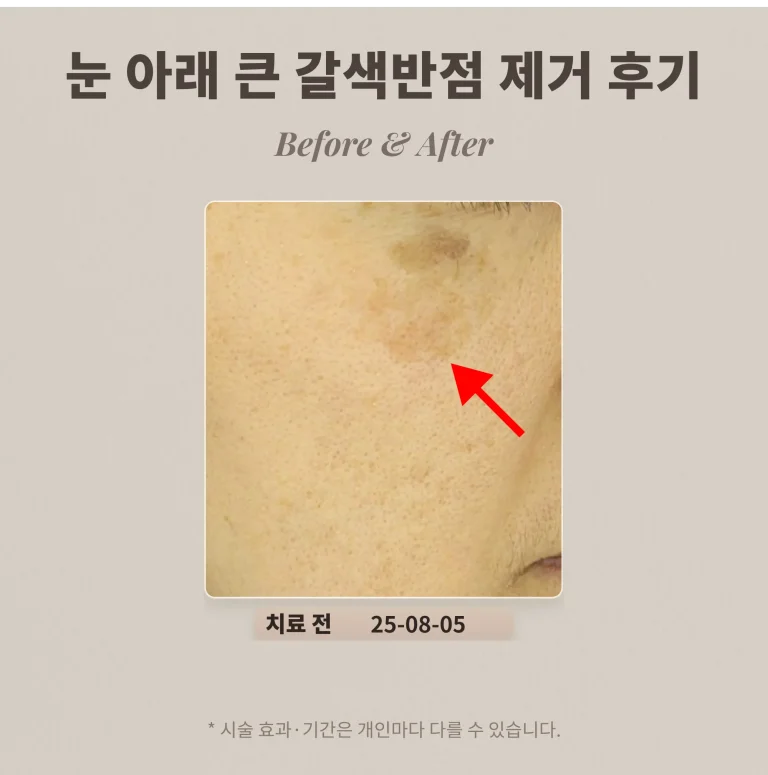 눈밑 흑자 제거 후기, 색소침착인 줄 알았던 큰 갈색 반점 (40대 여성)
