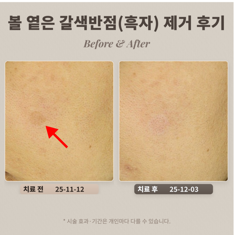 40대 여성 볼 부위 옅은 갈색반점(흑자) 제거 후기_강남 피부과 후기