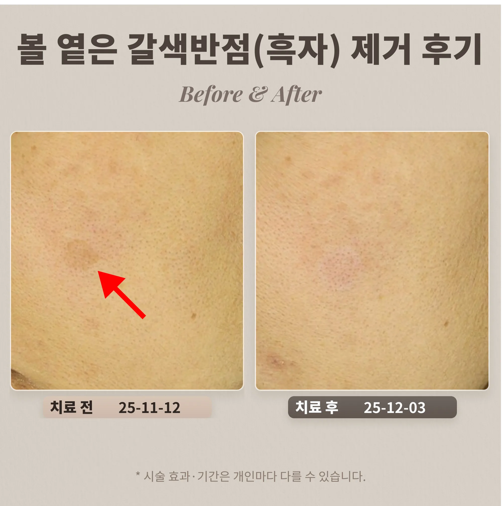 40대 여성 볼 부위 옅은 갈색반점(흑자) 제거 후기_강남 피부과 후기