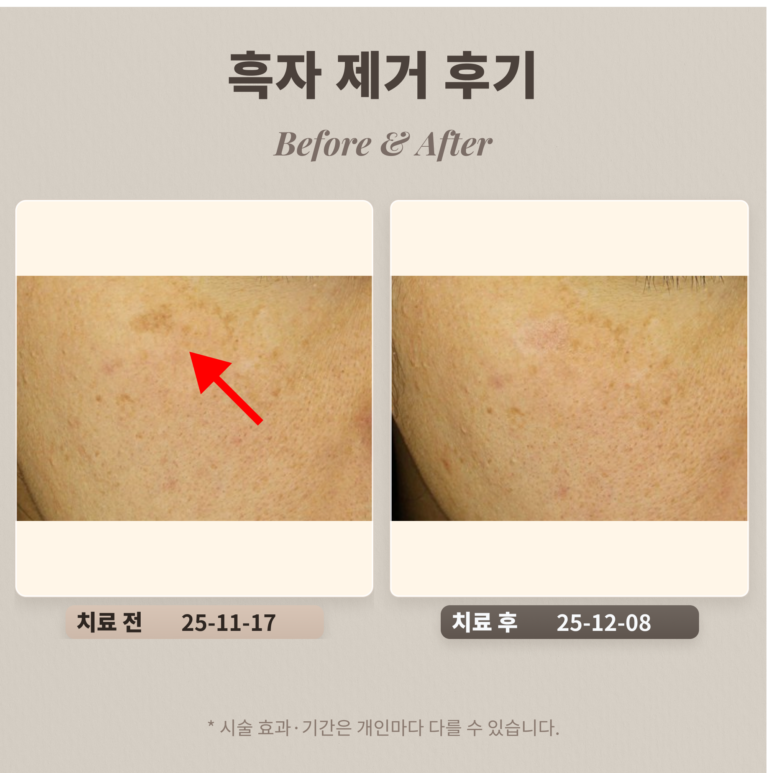 40대 흑자, 리팟레이저로 제거한 피부과 후기