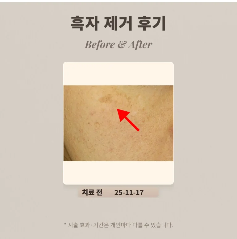 흑자 제거 레이저 후기, 광대 갈색 병변 리팟레이저 (40대 여성)