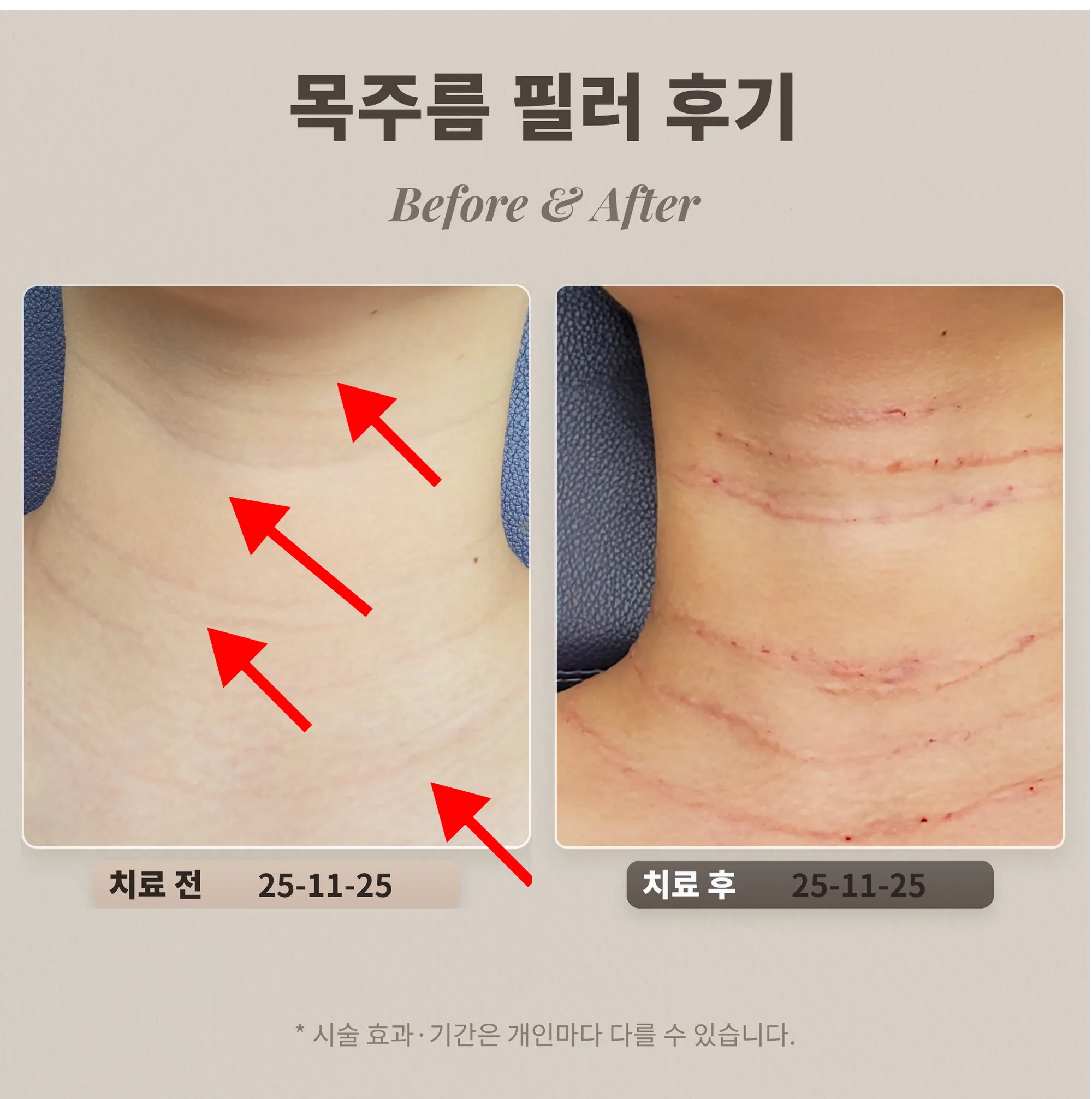 30대 여성 여러 줄 목주름 필러 시술 전과 시술 직후 비교