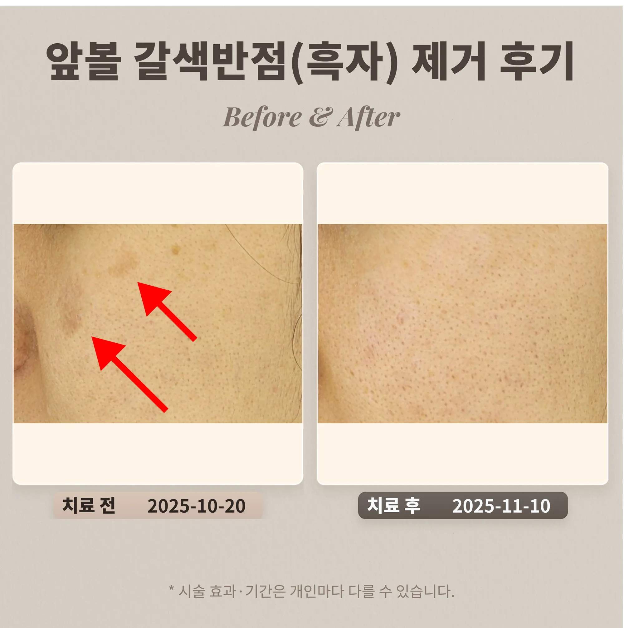 30대 앞볼 부위 갈색반점(색소침착)으로 알고 계셨던 여성의 흑자 제거 후기