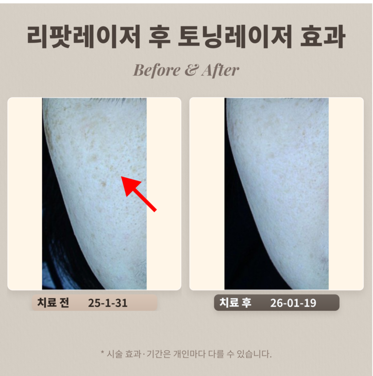 리팟레이저 후 토닝치료 어떤 효과가 있을까?