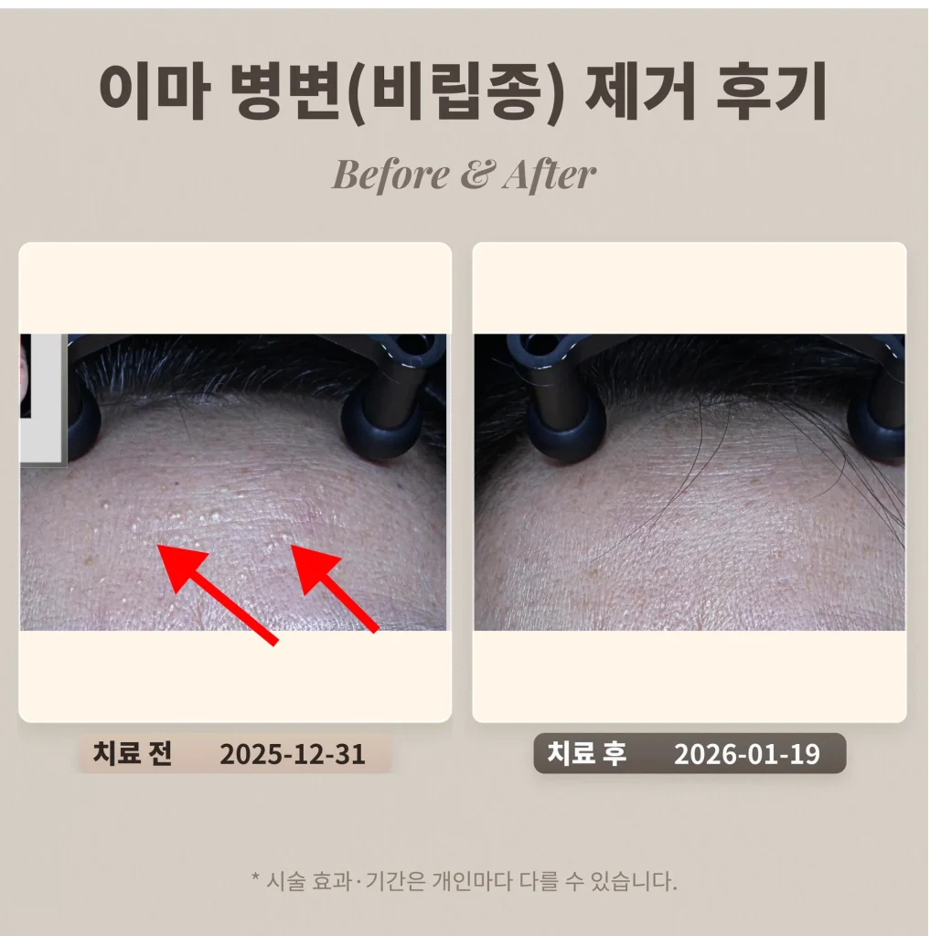 이마 오돌토돌 병변(비립종) 제거 후기_강남 피부과 전문의