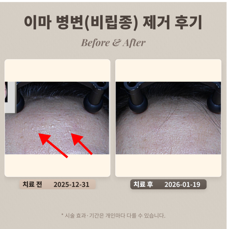 이마 오돌토돌 병변(비립종) 제거 후기_강남 피부과 전문의