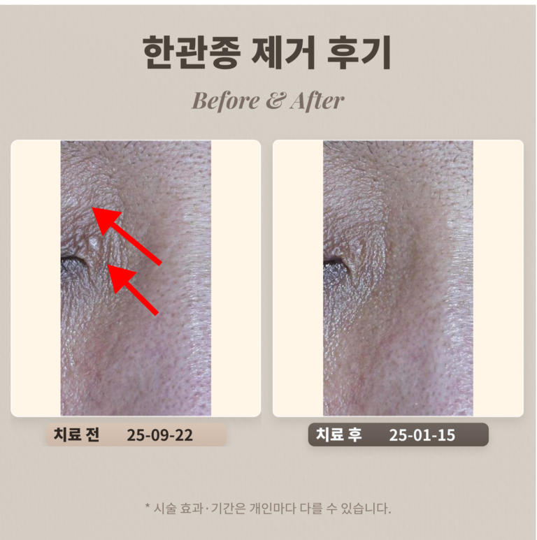 눈가 오돌토돌난 병변은 뭘까?한관종 제거 후기_강남 피부과 전문의