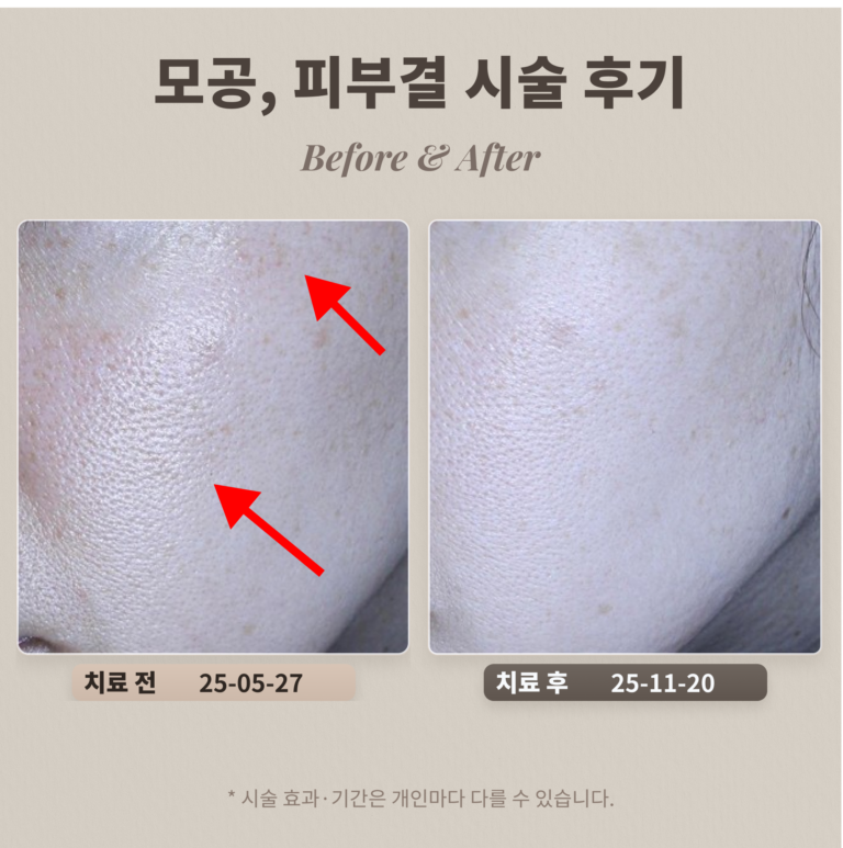 40대 모공과 피부결을 좋게 하려면, 피부과 시술 추천