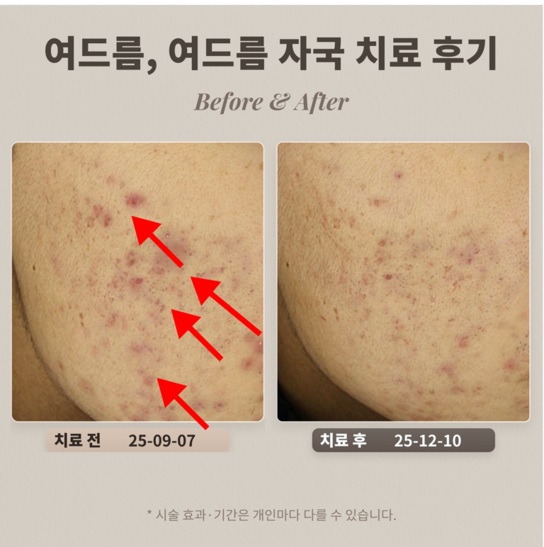 10대 여드름, 여드름 자국 치료 후기_대치동 여드름 피부과