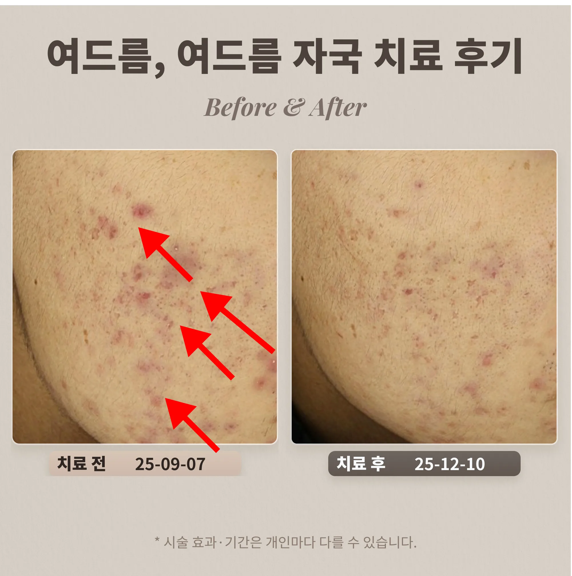 10대 여드름, 여드름 자국 치료 후기_대치동 여드름 피부과