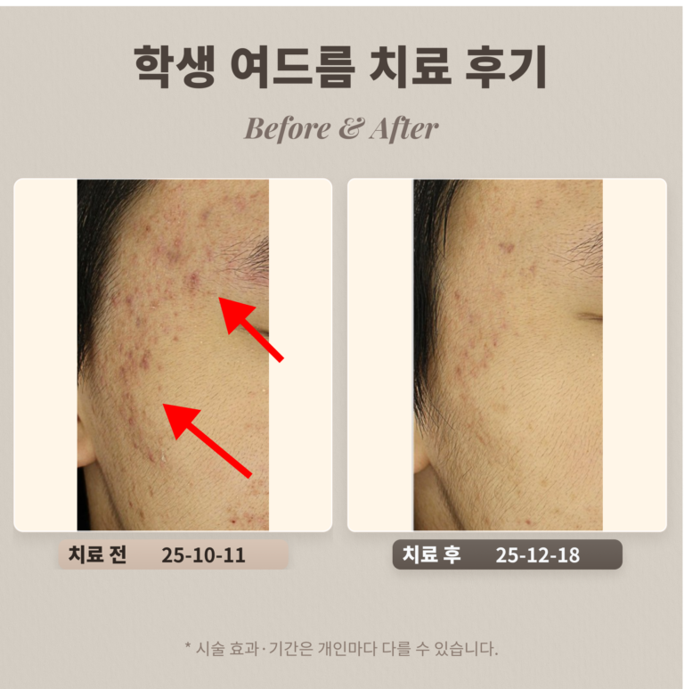 10대 학생 여드름 치료 후기_한티역 여드름 피부과