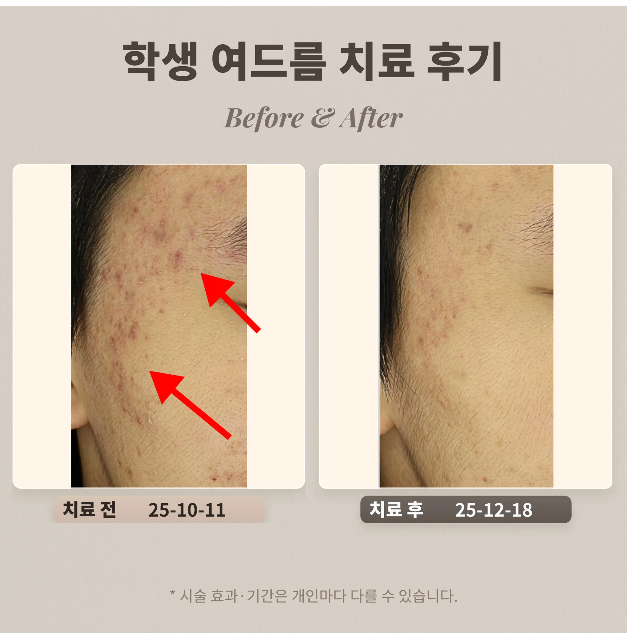 10대 학생 여드름 치료 후기_한티역 여드름 피부과