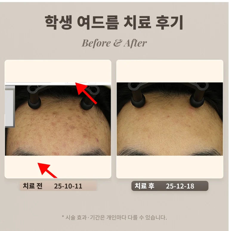 사춘기 여드름 치료 후기, T존과 양 볼의 염증성 여드름 (10대 남성)
