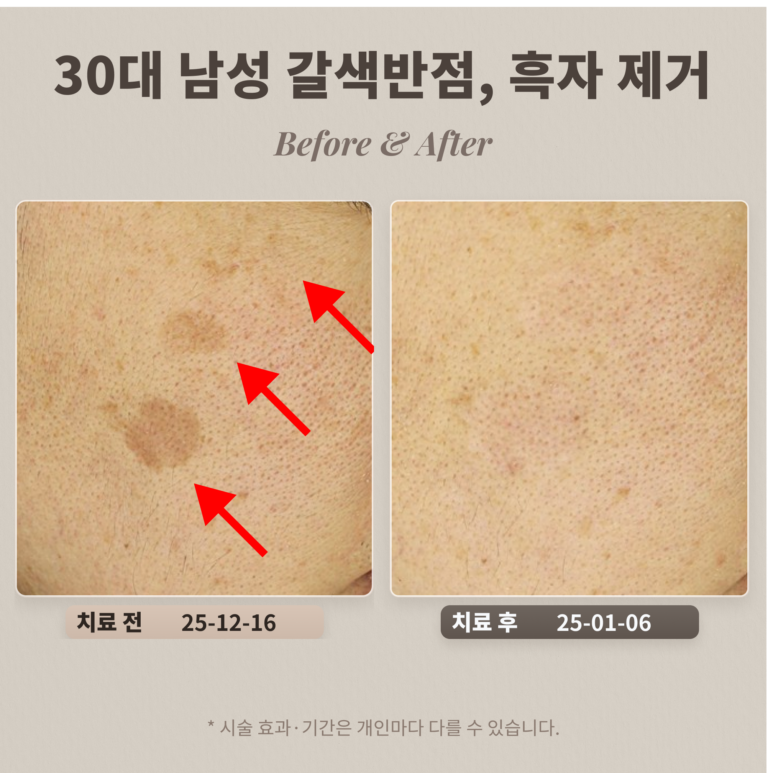 30대 남성 갈색반점, 흑자 제거 사례_리팟레이저 후기