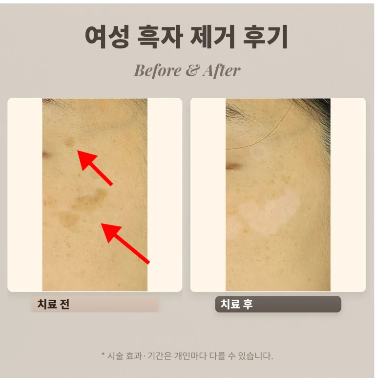 얼굴 흑자 후기, 광대에 퍼진 크고 작은 흑자 리팟레이저 치료 (40대 여성)