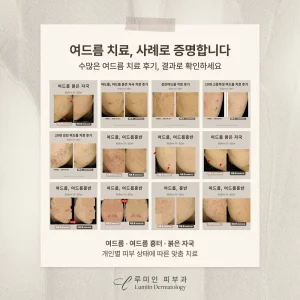 루미인피부과 여드름 치료 후기 공유