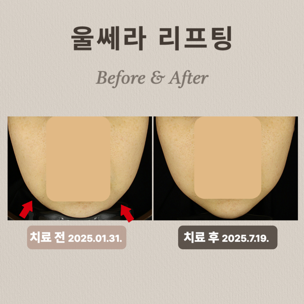 울쎄라 리프팅 Before & After - 정면
