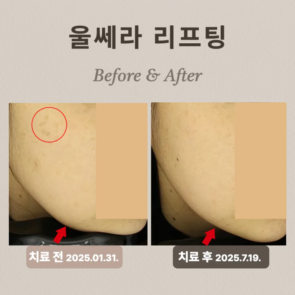 울쎄라 시술 사례