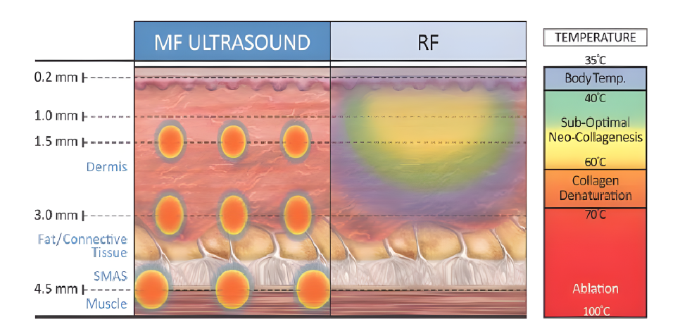 MF Ultrasound vs RF 에너지 비교