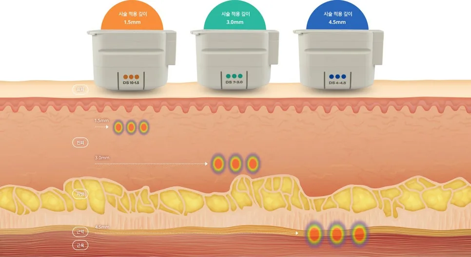 울쎄라 카트리지별 시술 깊이
