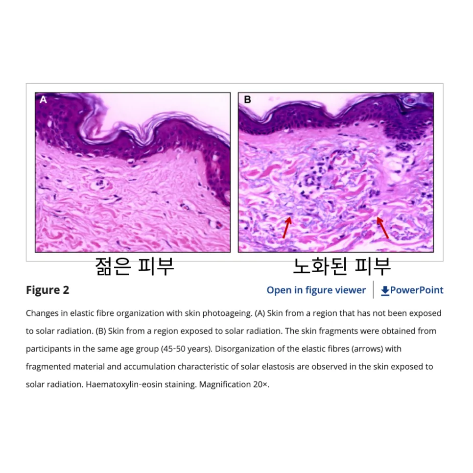젊은 피부와 노화된 피부의 진피층 비교