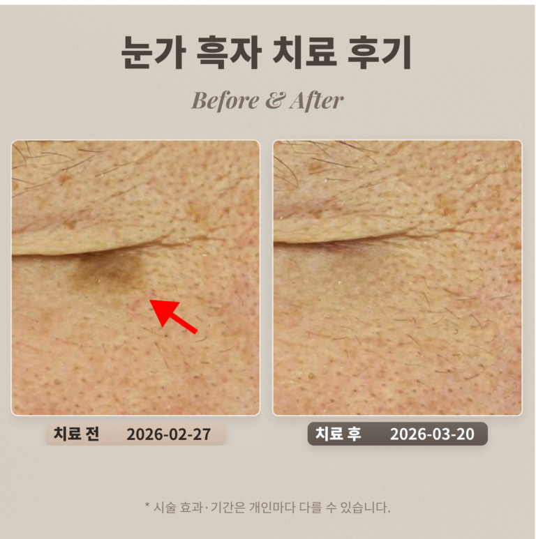 눈가 흑자 치료 후기