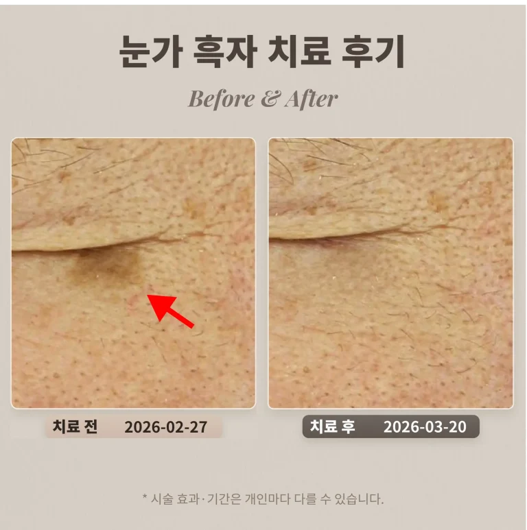 눈가 흑자 치료 후기