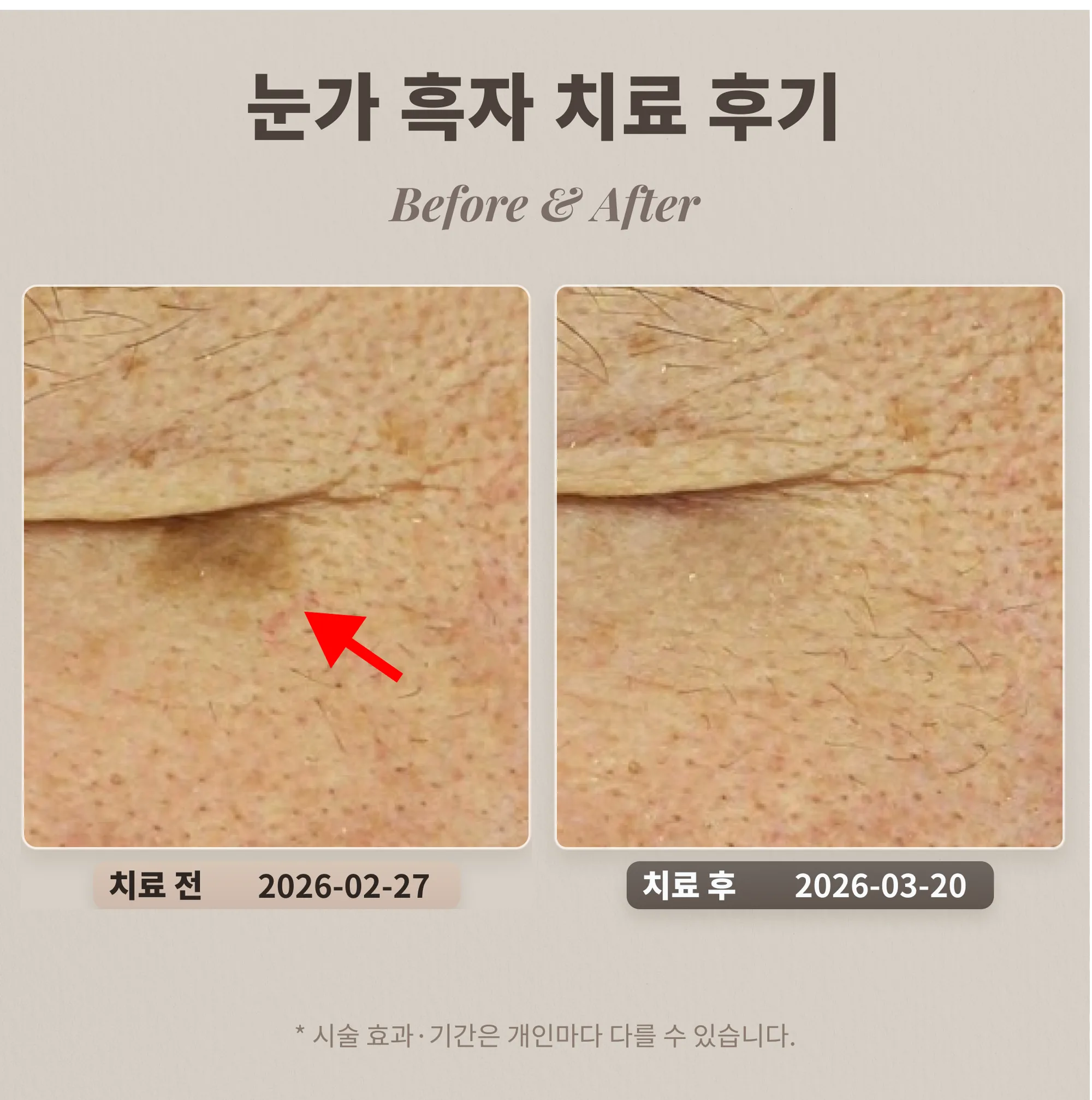 눈가 흑자 치료 후기