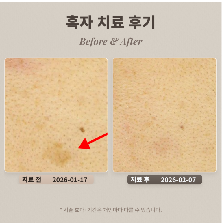 흑자 치료 후기