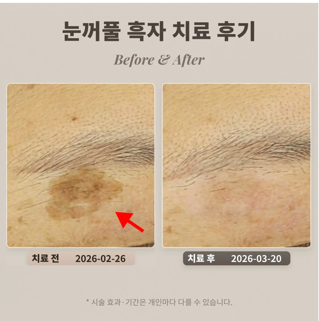 Eyelid Lentigo Treatment Review