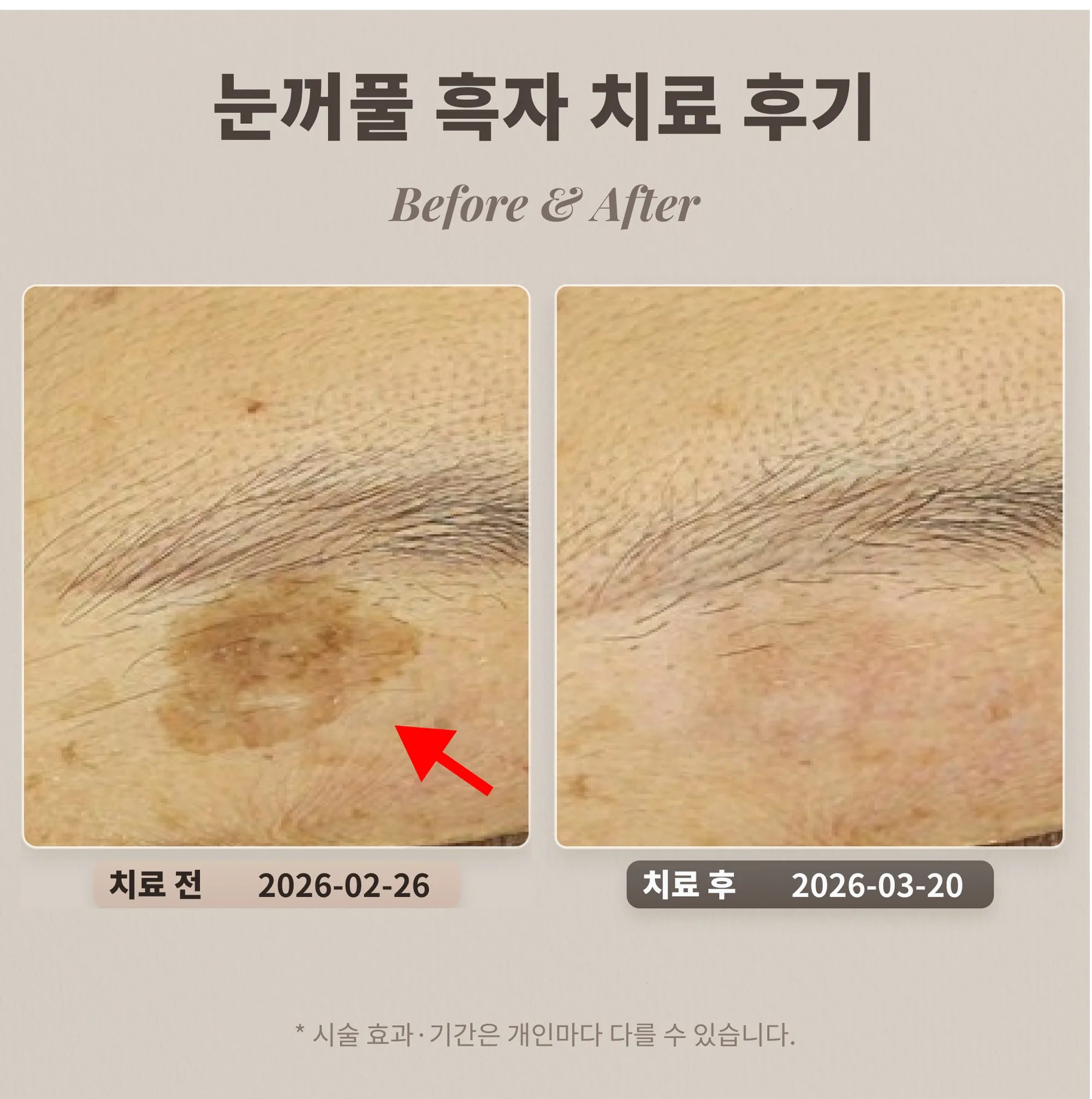 눈꺼풀 흑자 치료 후기