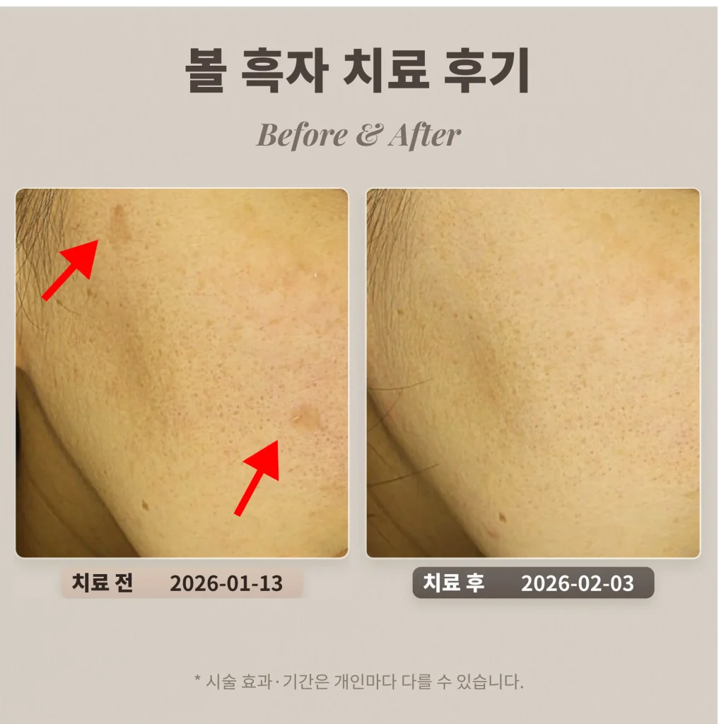 볼 흑자 치료 후기