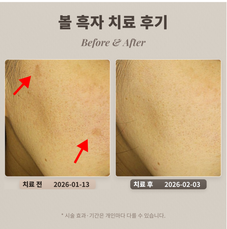 볼 흑자 치료 후기