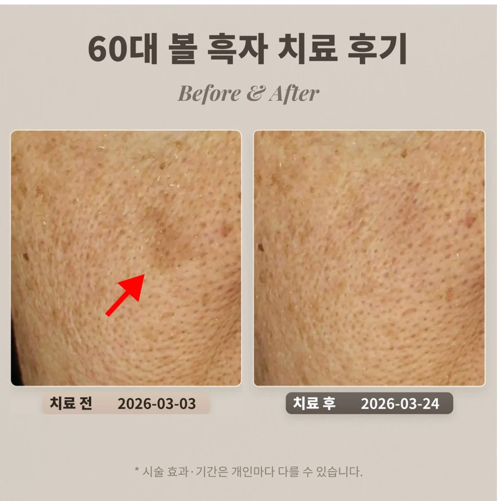 Cheek Lentigo Treatment in a Patient in Their 60s