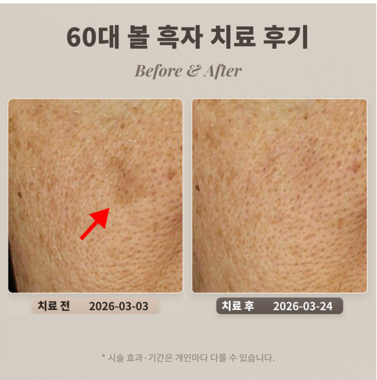 60대 볼 흑자 치료 후기