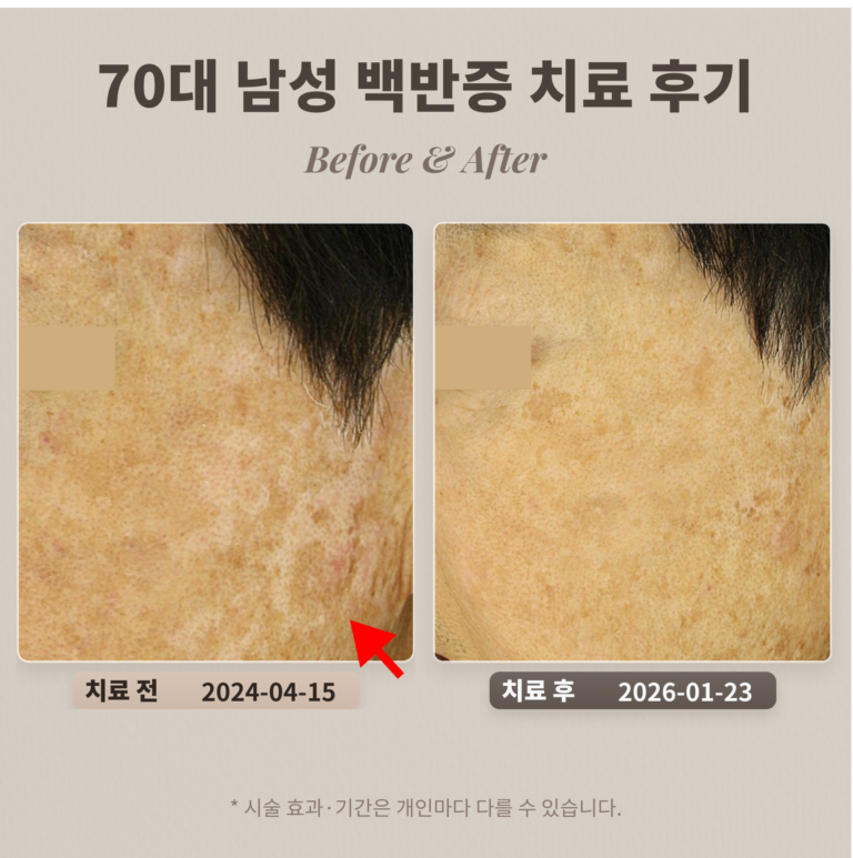 70대 남성 백반증 치료 후기