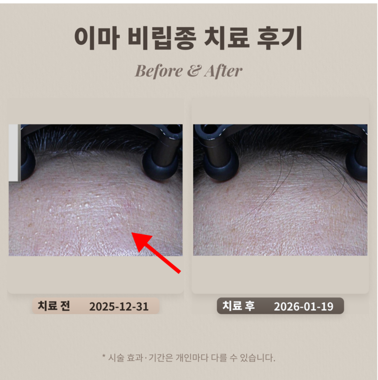 이마 비립종 치료 후기