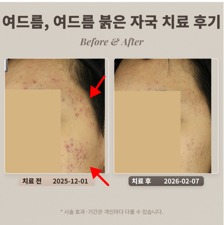 20대 관자, 볼 여드름, 여드름 붉은 자국 치료 후기