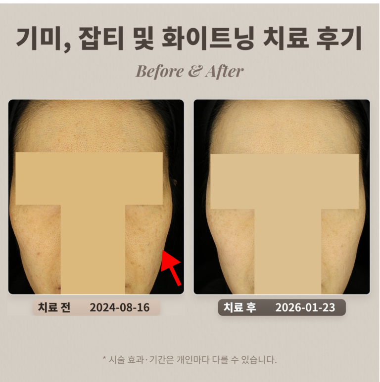 기미, 잡티 및 화이트닝(토닝) 치료 후기