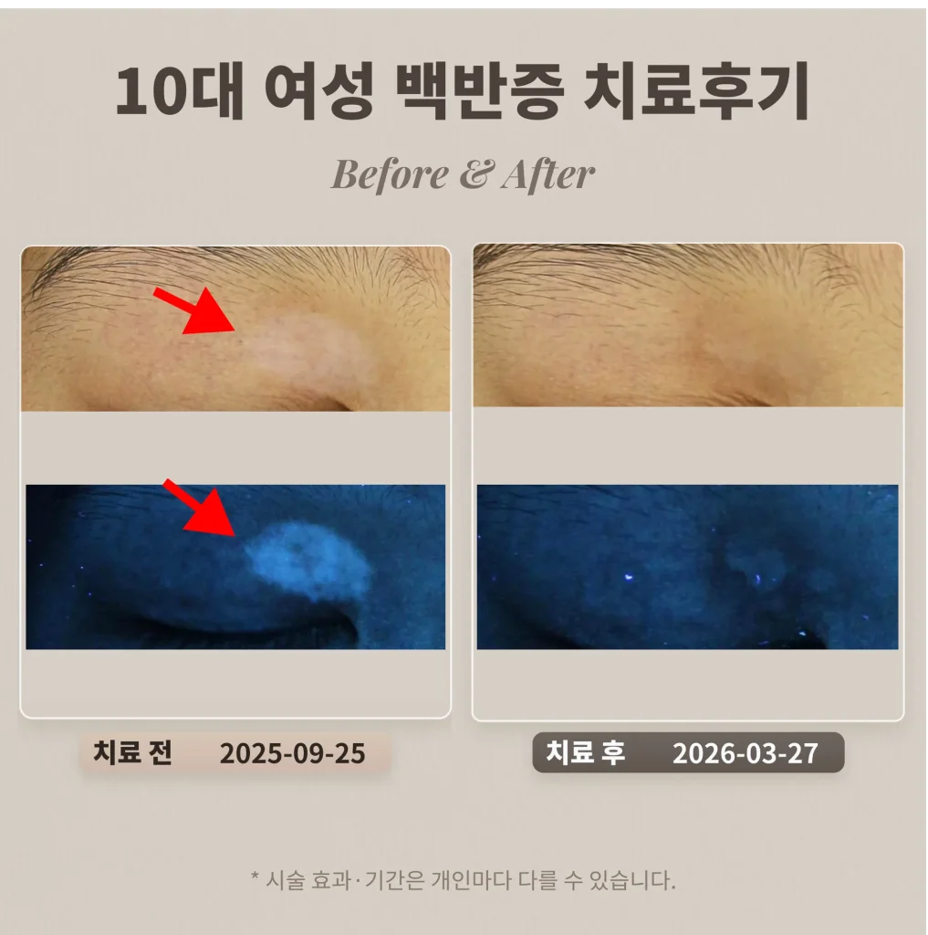 Vitiligo Treatment Review in a Teenage Girl