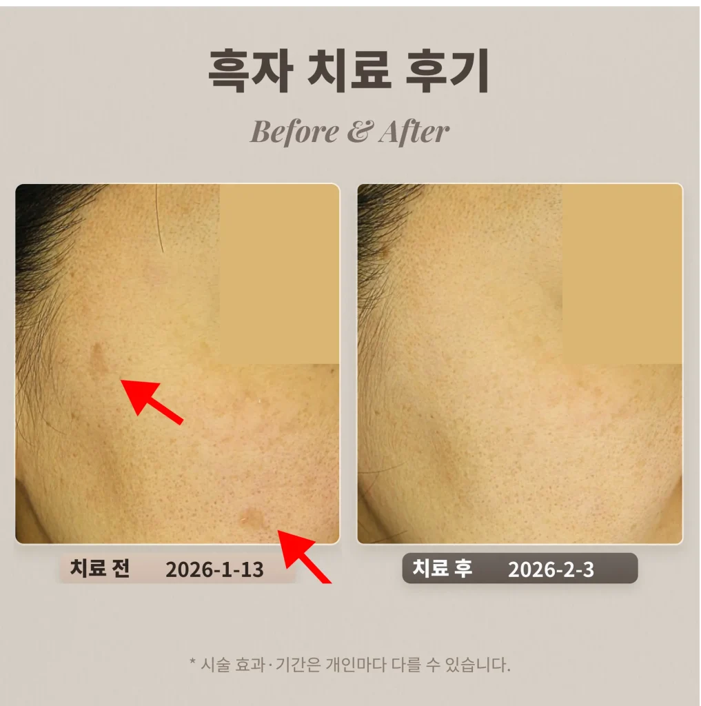 40代女性 日光黒子治療症例