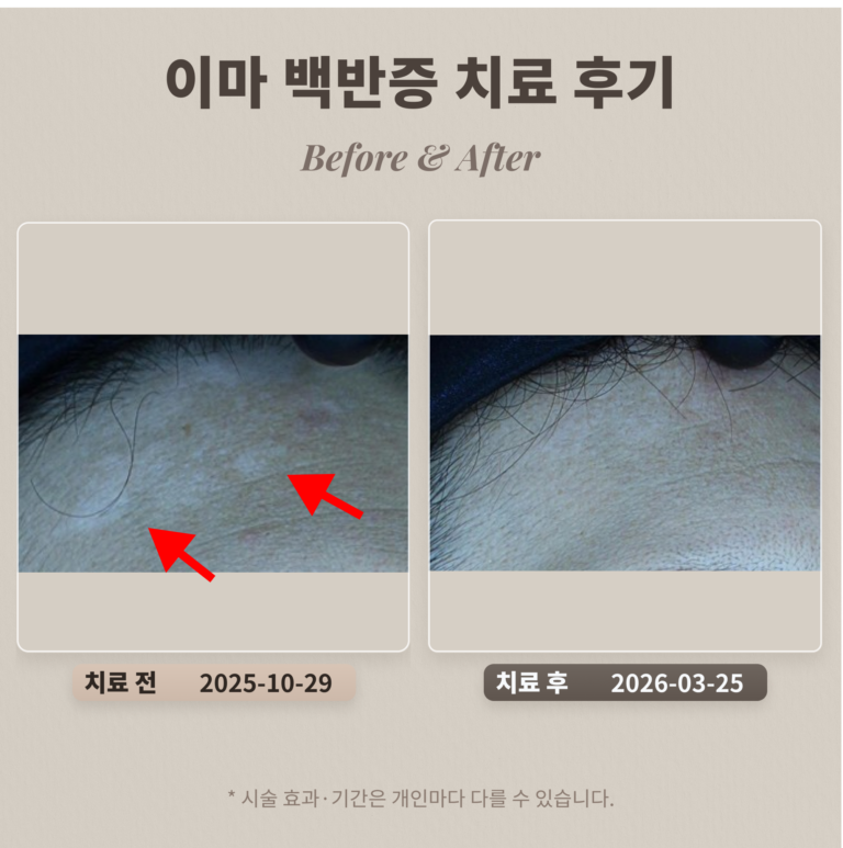 이마 백반증 치료 후기