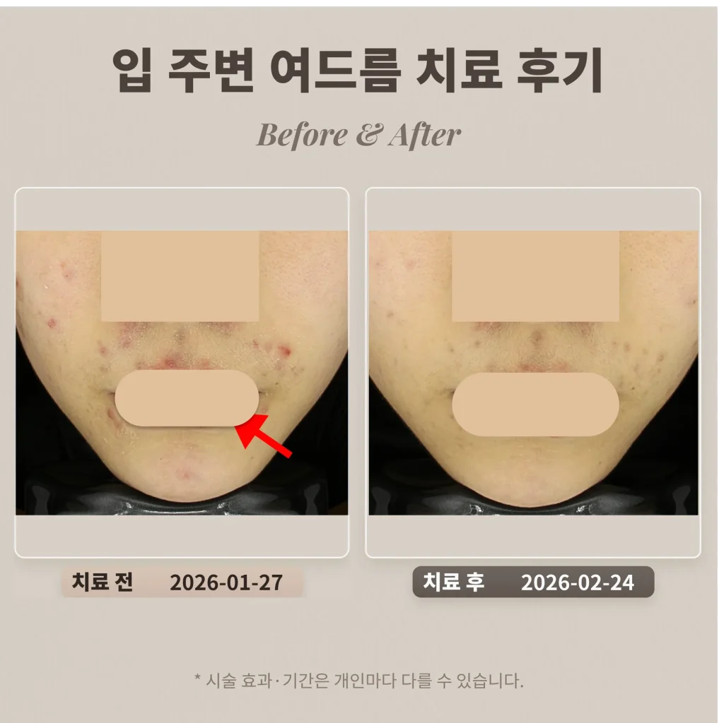 입 주변 여드름 치료 후기