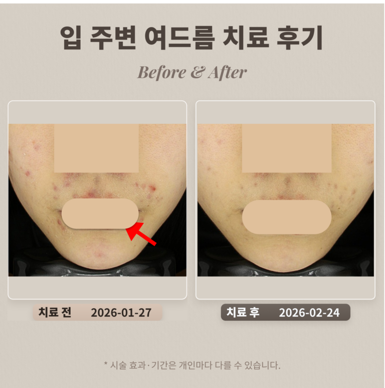입 주변 여드름 치료 후기