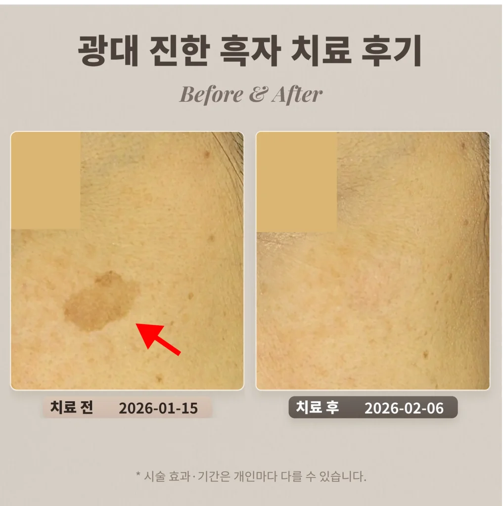 광대 진한 흑자 치료 후기