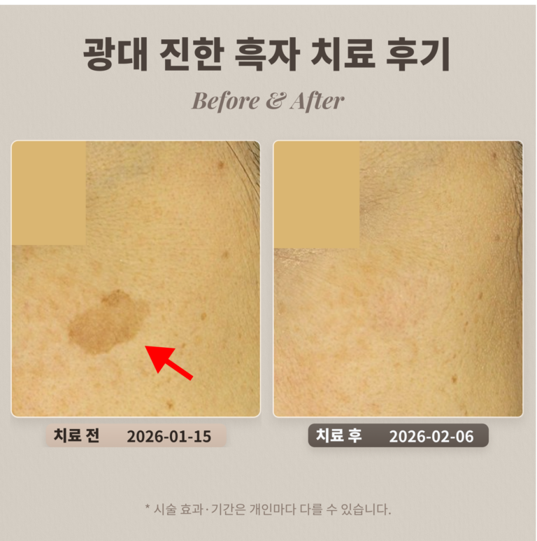 광대 진한 흑자 치료 후기