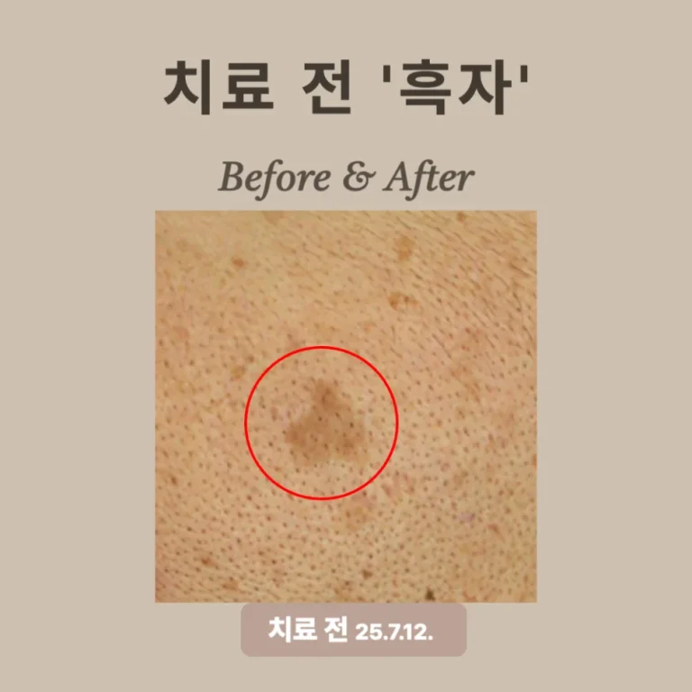 50대 리팟레이저 시술 후기: 경계 뚜렷한 흑자 제거 성공!